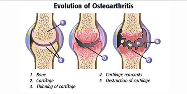 osteoarthritis